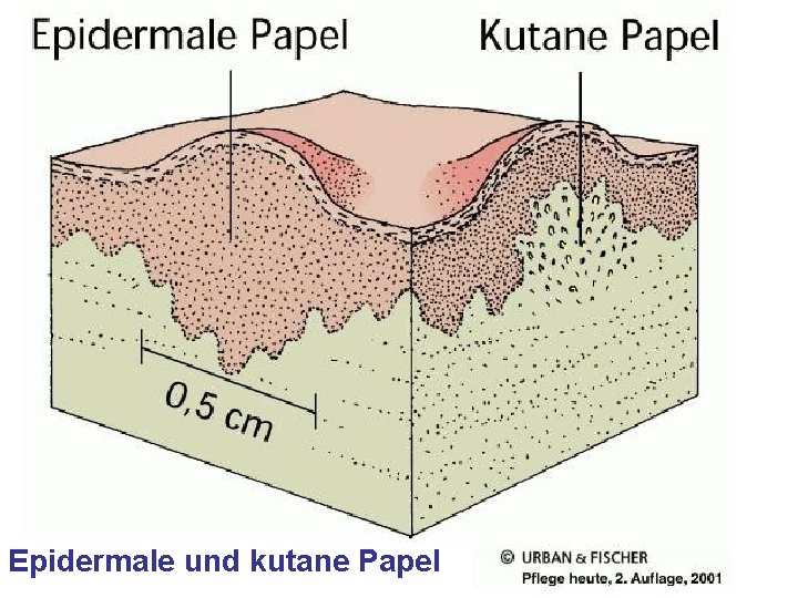 Epidermale und kutane Papel Epidermale und kutane Papel