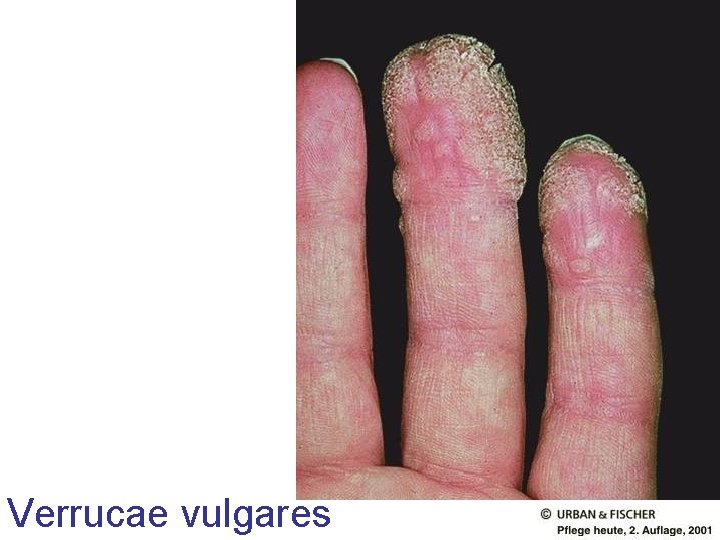 Verrucae vulgares Verrucae vulgares