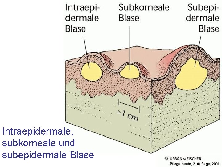 Intraepidermale, subkorneale und subepidermale Blase Intraepidermale, subkorneale und subepidermale Blase