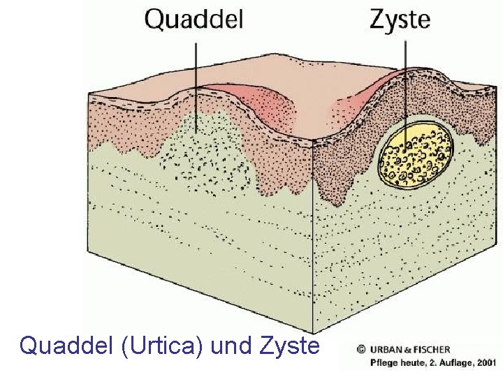 Quaddel (Urtica) und Zyste Quaddel (Urtica) und Zyste