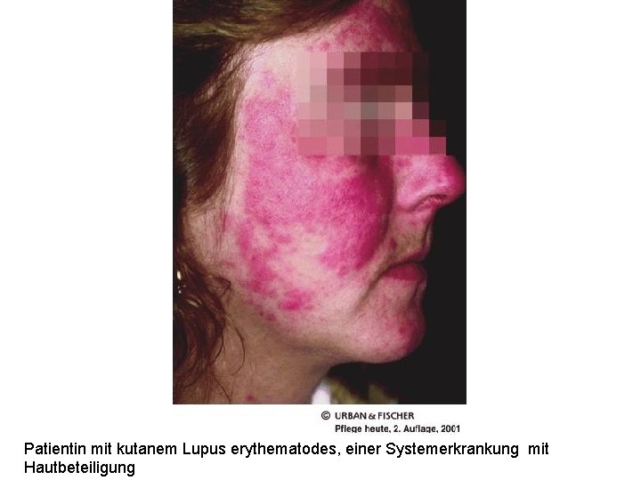 Patientin mit kutanem Lupus erythematodes, einer Systemerkrankung mit Hautbeteiligung Patientin mit kutanem Lupus erythematodes, einer Systemerkrankung mit Hautbeteiligung