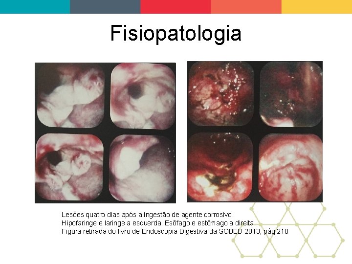 Fisiopatologia Lesões quatro dias após a ingestão de agente corrosivo. Hipofaringe e laringe a