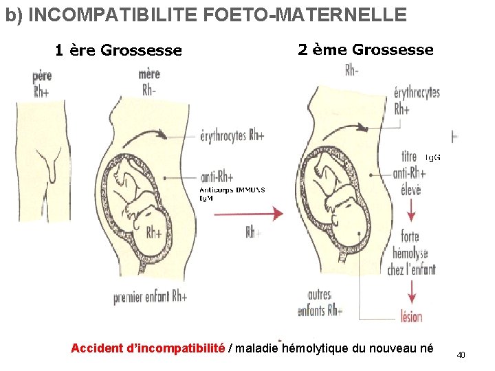 b) INCOMPATIBILITE FOETO-MATERNELLE Accident d’incompatibilité / maladie hémolytique du nouveau né 40 