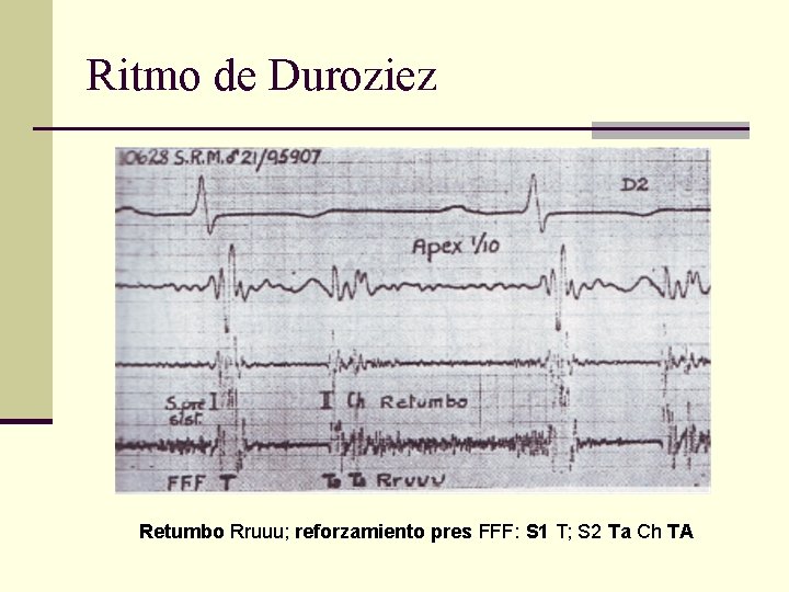 Ritmo de Duroziez Retumbo Rruuu; reforzamiento pres FFF: S 1 T; S 2 Ta