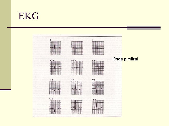 EKG Onda p mitral 