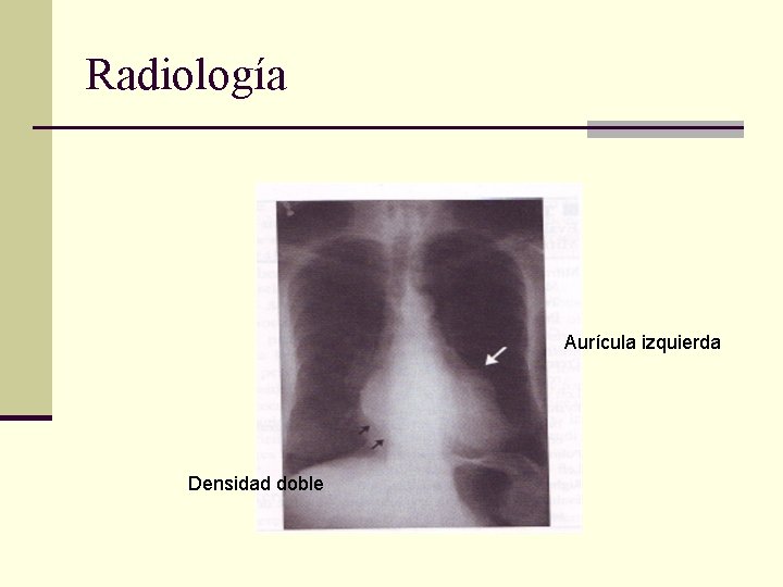 Radiología Aurícula izquierda Densidad doble 