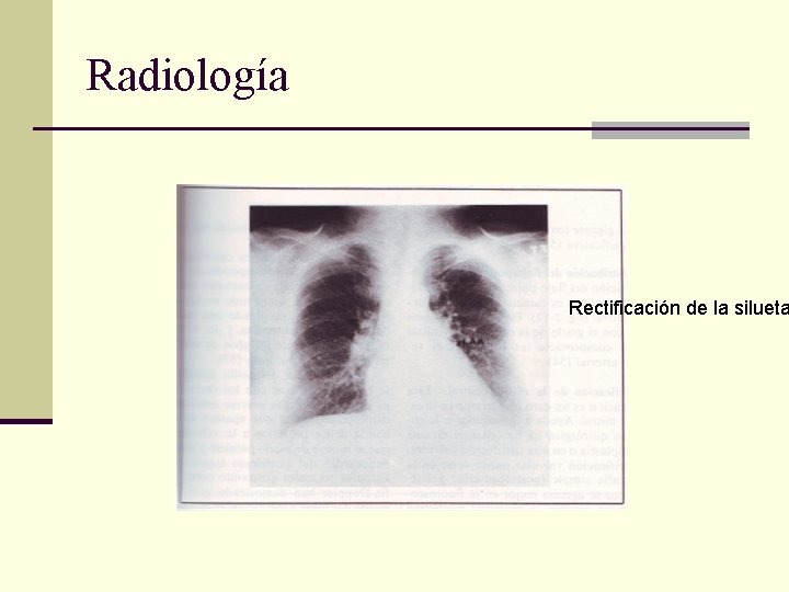 Radiología Rectificación de la silueta 