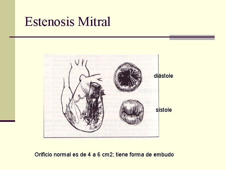 Estenosis Mitral diástole sístole Orificio normal es de 4 a 6 cm 2; tiene
