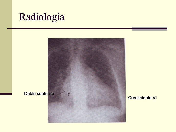 Radiología Doble contorno Crecimiento VI 