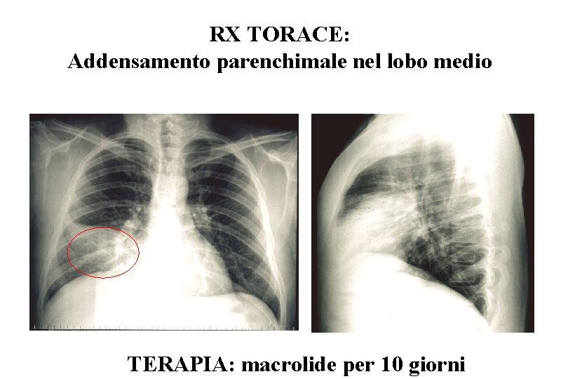 RX TORACE: Addensamento parenchimale nel lobo medio TERAPIA: macrolide per 10 giorni 