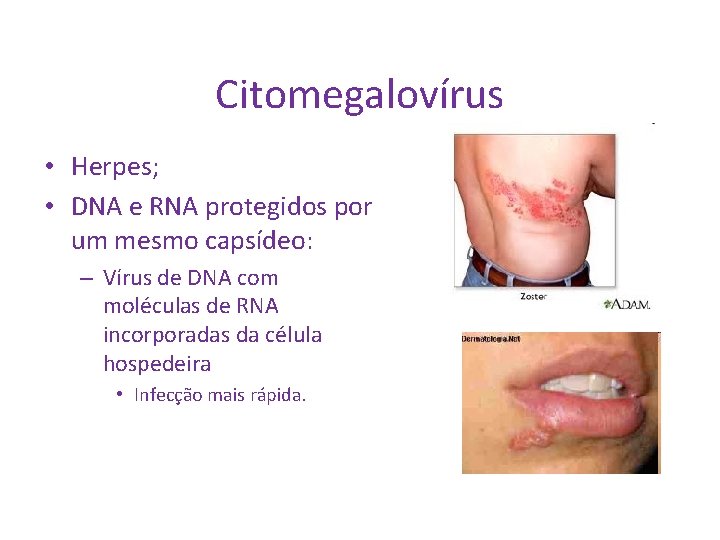 Citomegalovírus • Herpes; • DNA e RNA protegidos por um mesmo capsídeo: – Vírus