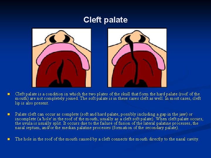 Cleft palate n Cleft palate is a condition in which the two plates of