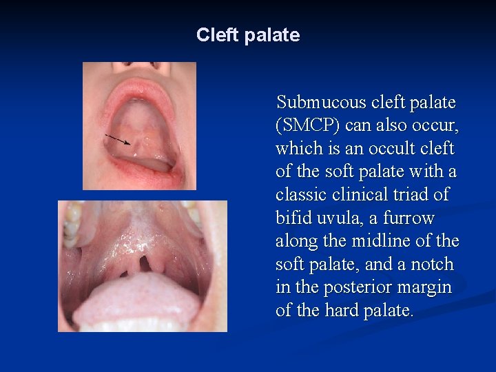 Cleft palate Submucous cleft palate (SMCP) can also occur, which is an occult cleft