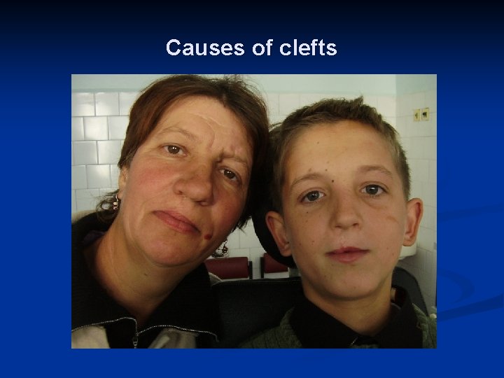 Causes of clefts 