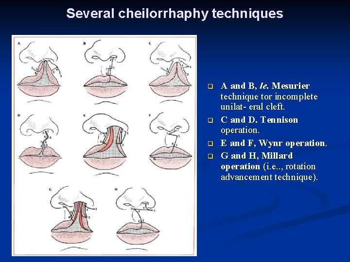 Several cheilorrhaphy techniques q q A and B, le. Mesurier technique tor incomplete unilat-