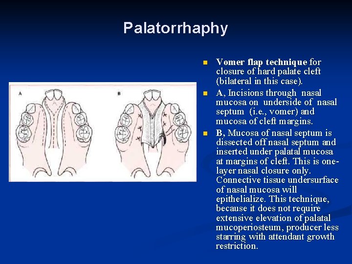 Palatorrhaphy n n n Vomer flap technique for closure of hard palate cleft (bilateral