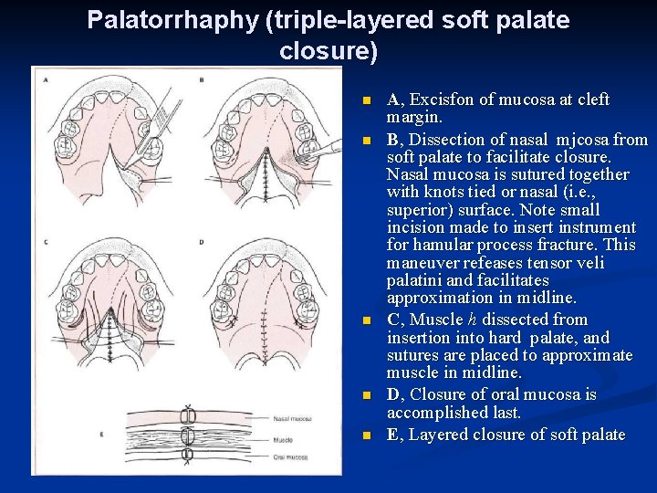 Palatorrhaphy (triple-layered soft palate closure) n n n A, Excisfon of mucosa at cleft