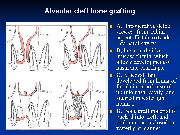 Alveolar cleft bone grafting n n A, Preoperative defect viewed from labial aspect. Fistula