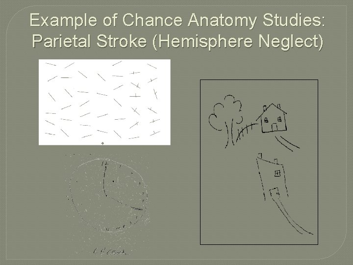 Example of Chance Anatomy Studies: Parietal Stroke (Hemisphere Neglect) 