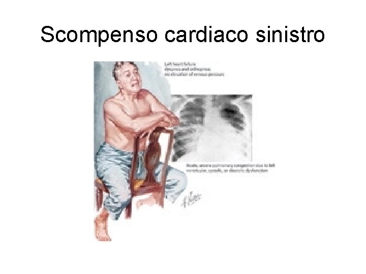 Scompenso cardiaco sinistro 