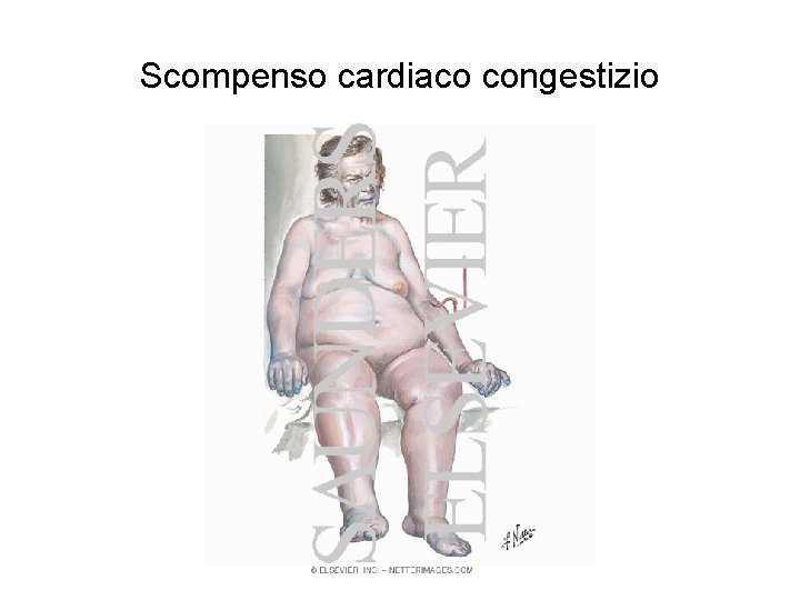 Scompenso cardiaco congestizio 