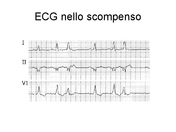 ECG nello scompenso 