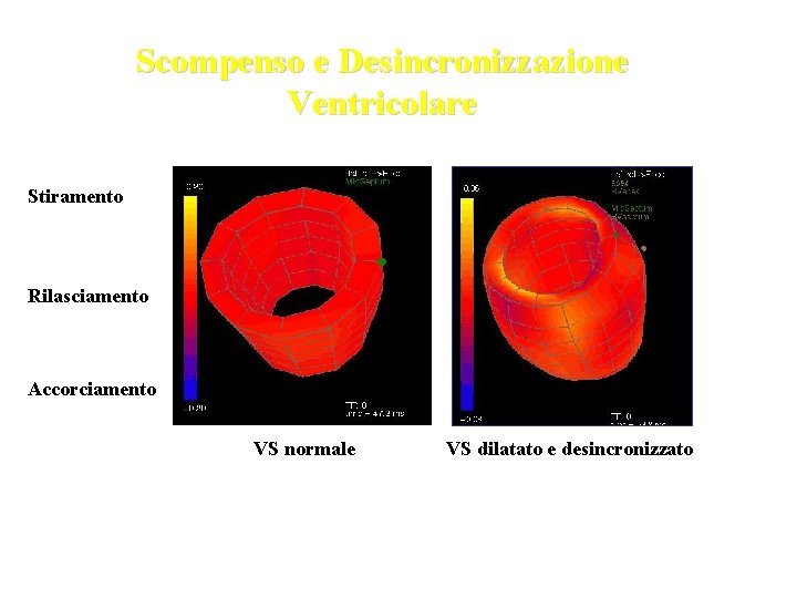 Scompenso e Desincronizzazione Ventricolare Stiramento Rilasciamento Accorciamento VS normale VS dilatato e desincronizzato 