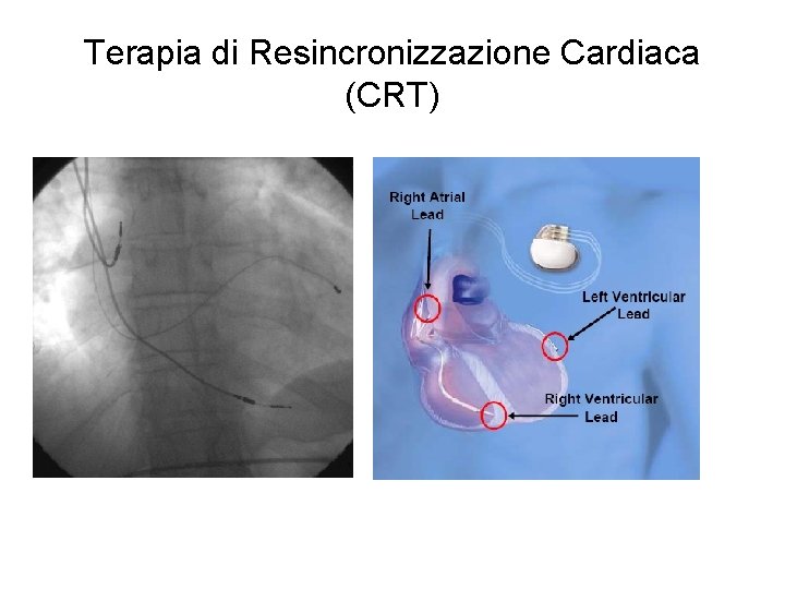 Terapia di Resincronizzazione Cardiaca (CRT) 