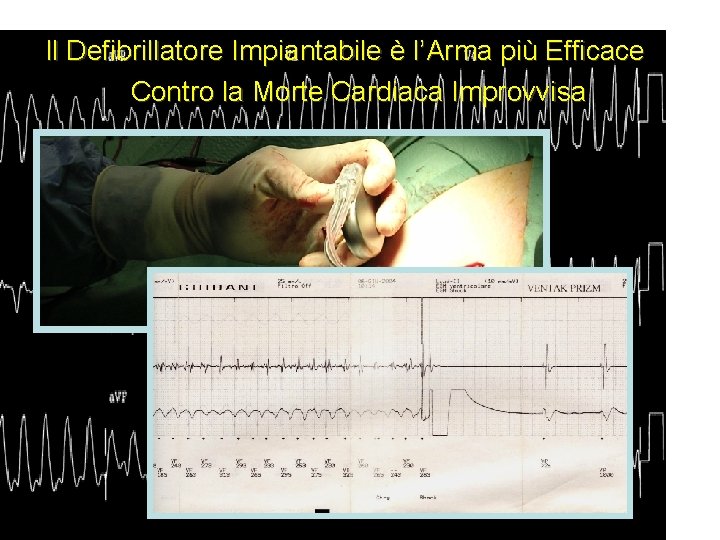 Il Defibrillatore Impiantabile è l’Arma più Efficace Contro la Morte Cardiaca Improvvisa 