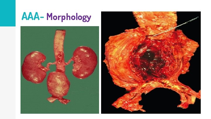 AAA- Morphology 