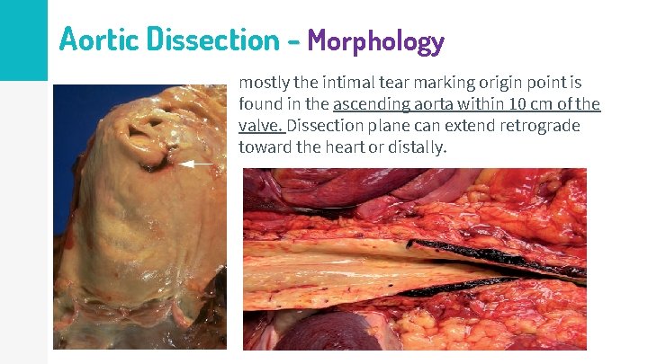 Aortic Dissection - Morphology mostly the intimal tear marking origin point is found in