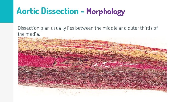 Aortic Dissection - Morphology Dissection plan usually lies between the middle and outer thirds