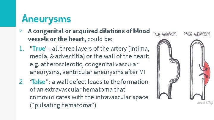 Aneurysms ▹ A congenital or acquired dilations of blood vessels or the heart, could