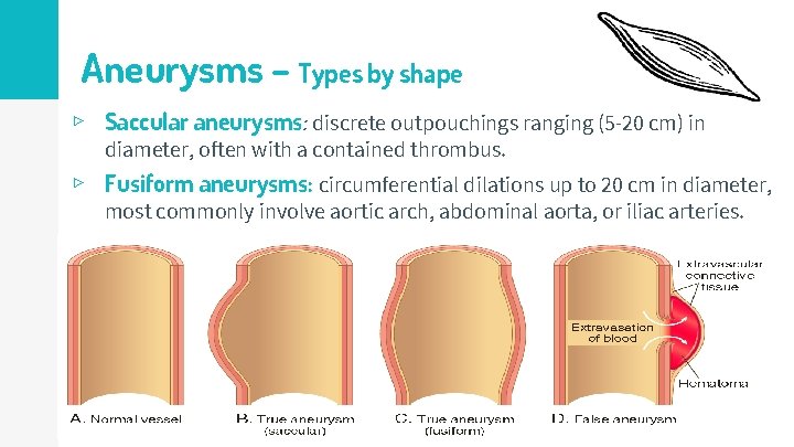 Aneurysms – Types by shape ▹ Saccular aneurysms: discrete outpouchings ranging (5 -20 cm)