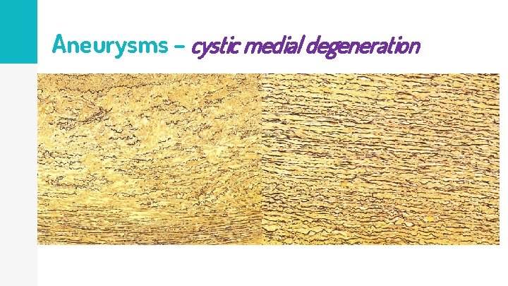 Aneurysms – cystic medial degeneration 