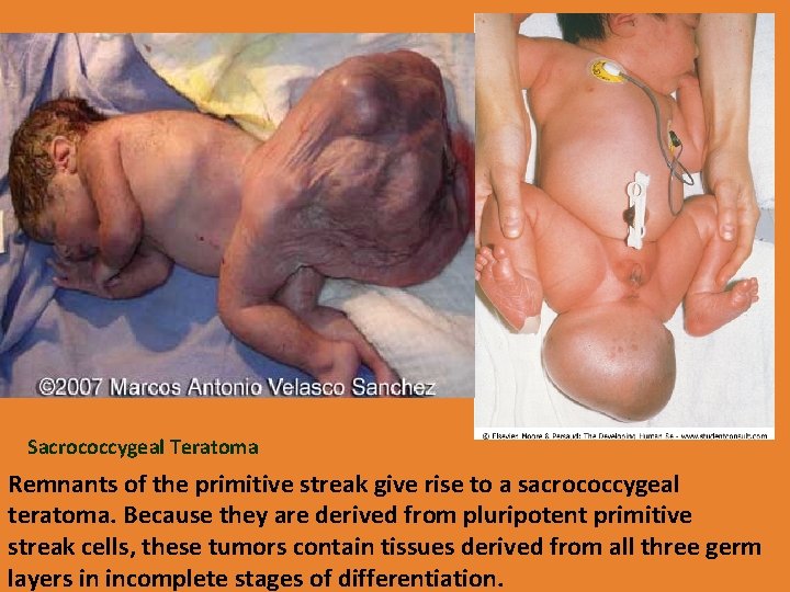 Sacrococcygeal Teratoma Remnants of the primitive streak give rise to a sacrococcygeal teratoma. Because