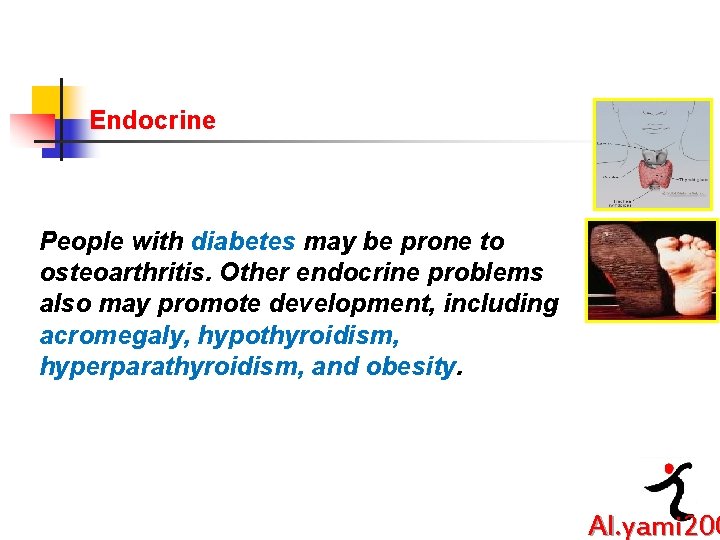 Endocrine People with diabetes may be prone to osteoarthritis. Other endocrine problems also may