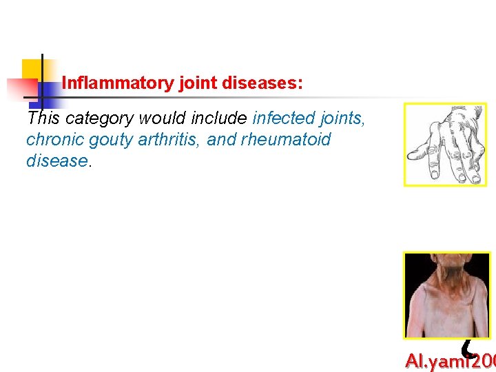 Inflammatory joint diseases: This category would include infected joints, chronic gouty arthritis, and rheumatoid