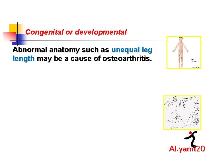 Congenital or developmental Abnormal anatomy such as unequal leg length may be a cause