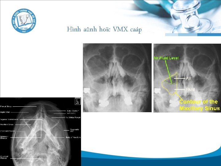 Hình aûnh hoïc VMX caáp 