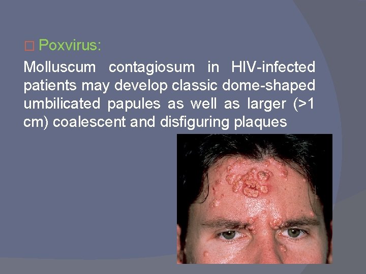 � Poxvirus: Molluscum contagiosum in HIV-infected patients may develop classic dome-shaped umbilicated papules as