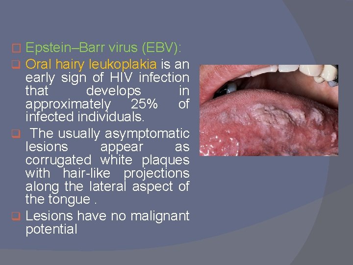 Epstein–Barr virus (EBV): Oral hairy leukoplakia is an early sign of HIV infection that