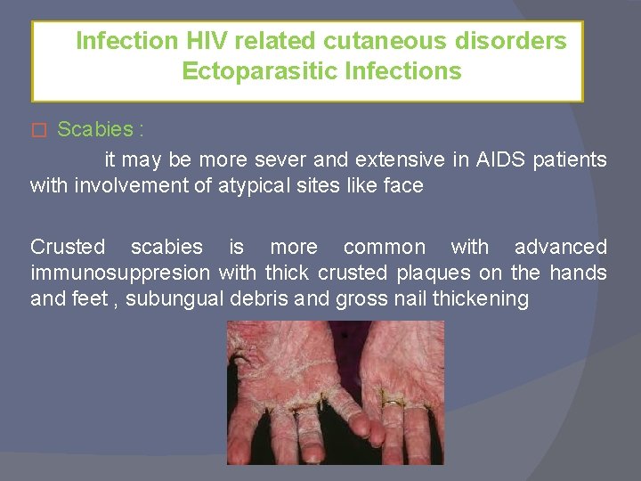 Infection HIV related cutaneous disorders Ectoparasitic Infections Scabies : it may be more sever