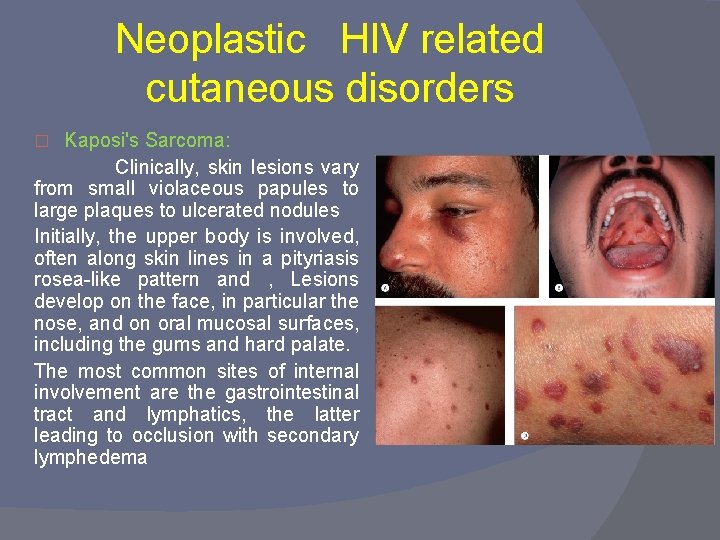 Neoplastic HIV related cutaneous disorders Kaposi's Sarcoma: Clinically, skin lesions vary from small violaceous