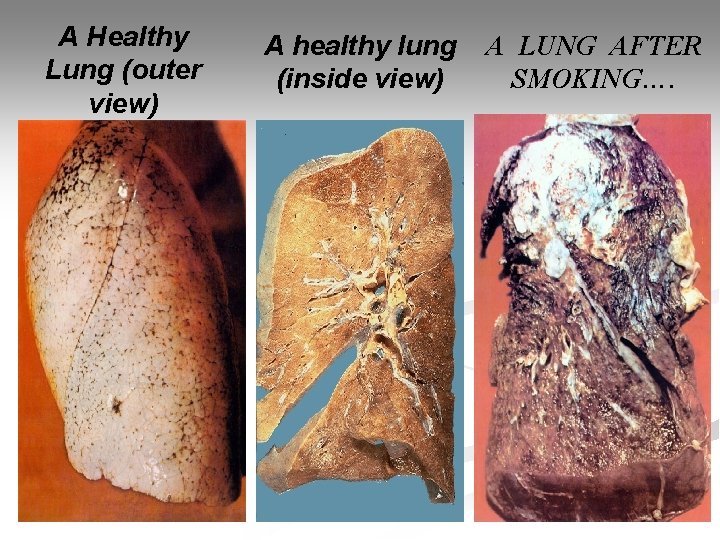 A Healthy Lung (outer view) A healthy lung (inside view) A LUNG AFTER SMOKING….