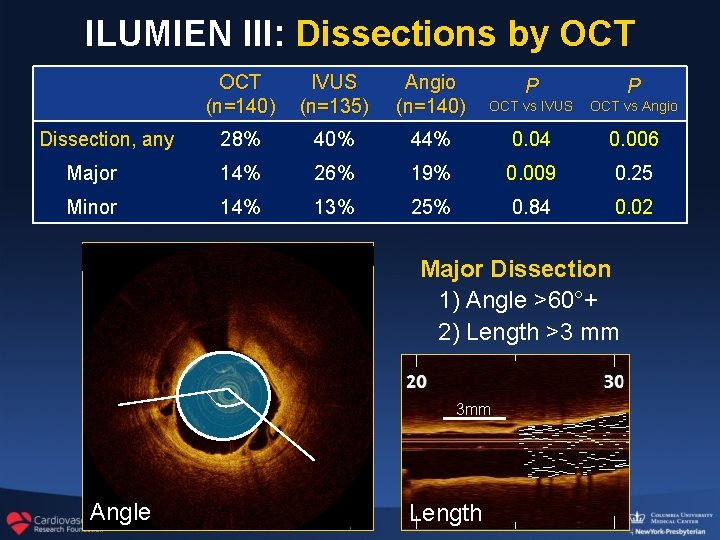 ILUMIEN III: Dissections by OCT (n=140) IVUS (n=135) Angio (n=140) P P OCT vs