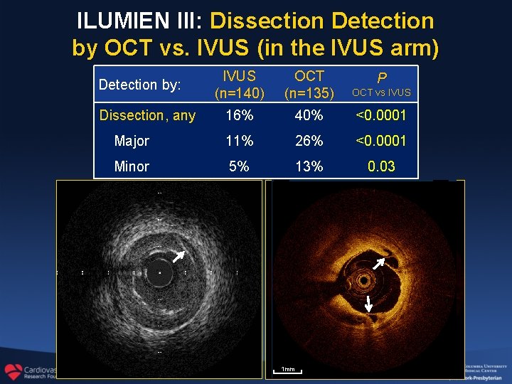 ILUMIEN III: Dissection Detection by OCT vs. IVUS (in the IVUS arm) IVUS (n=140)