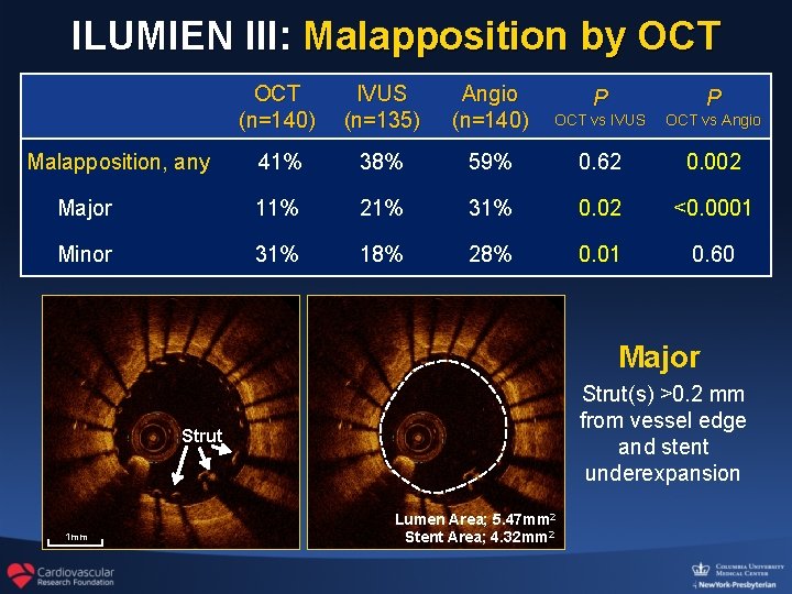 ILUMIEN III: Malapposition by OCT (n=140) IVUS (n=135) Angio (n=140) P P OCT vs