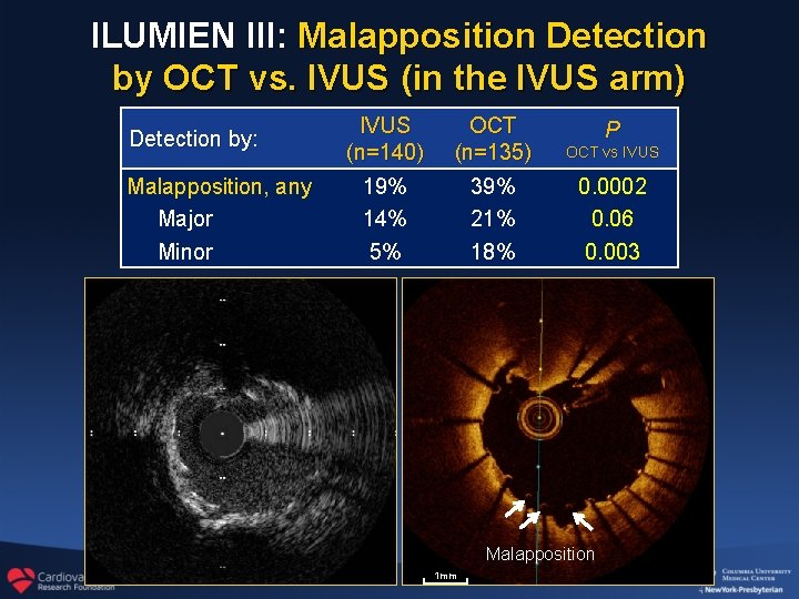 ILUMIEN III: Malapposition Detection by OCT vs. IVUS (in the IVUS arm) Detection by: