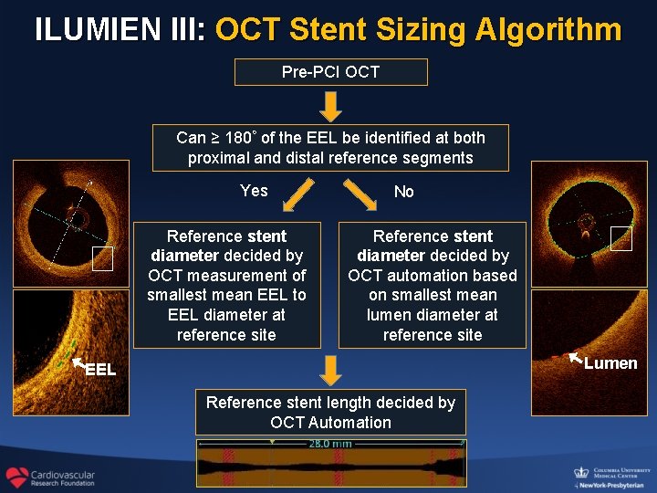 ILUMIEN III: OCT Stent Sizing Algorithm Pre-PCI OCT Can ≥ 180◦ of the EEL